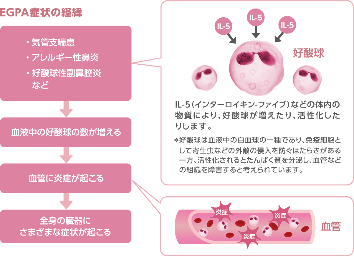 EGPA症状の経緯